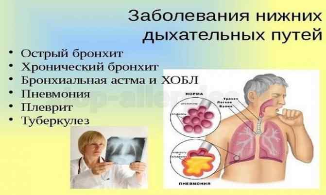flemoksin-primenyayut-pri-vospalitelnyh-processah-v-nizhnih-dyhatelnyh-putyah