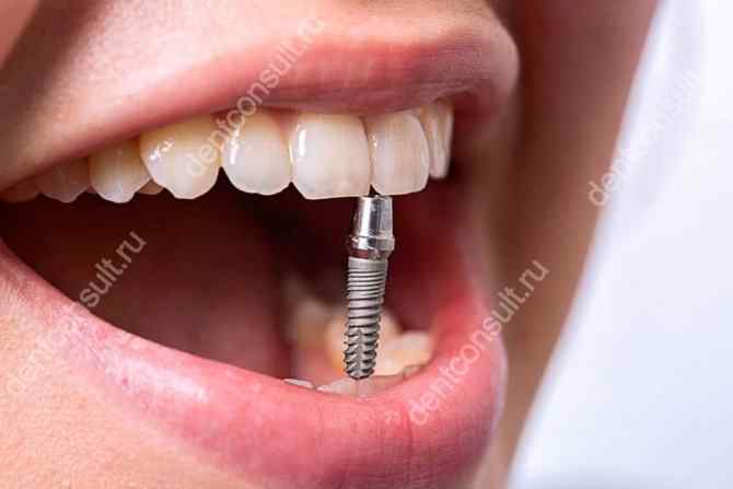 implantaciya