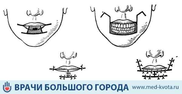 operaciya-pri-rake-nizhnej-guby